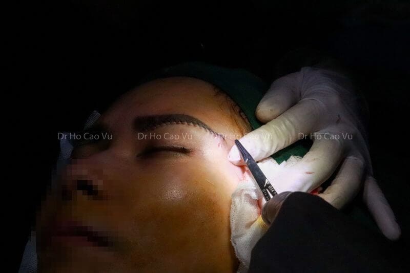 seo sau khi nang cung chan may 2