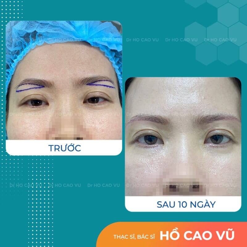 seo sau khi nang cung chan may 1